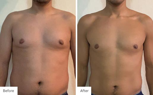 3- Before and After of a man's torso using NeoraFit.