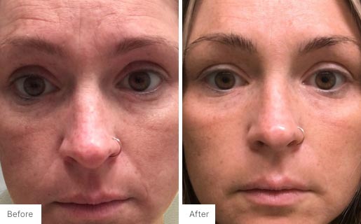 1 - Before and After Real Results of Age IQ Day Cream on a woman's face